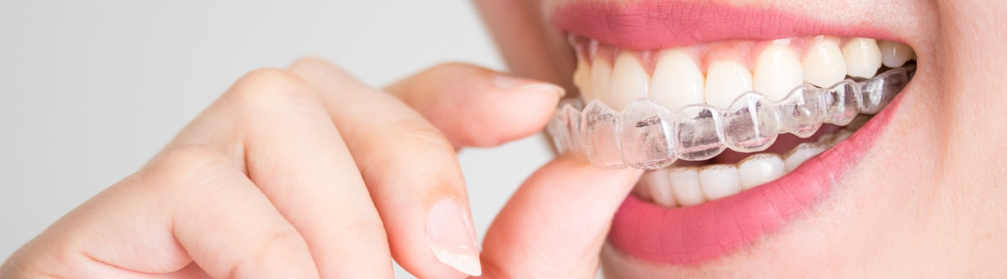 Alinhador Transparente - COSB Clínica Odontológica